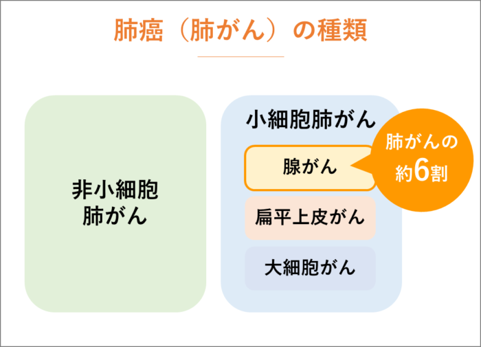 肺癌（肺がん）の種類と症状