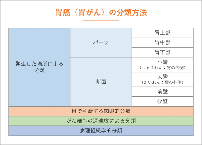 胃癌（胃がん）の種類と症状