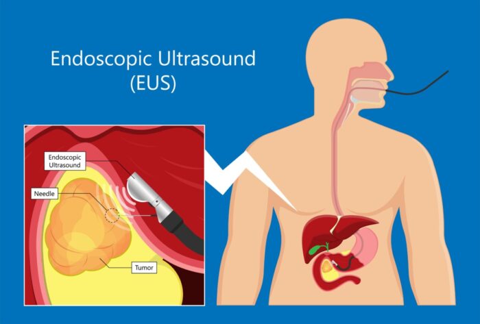 超音波内視鏡検査（EUS）：胃がんの深達度やリンパ節転移の評価