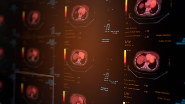 PET-CT検査：胃がんの広がりと進行度をチェックする