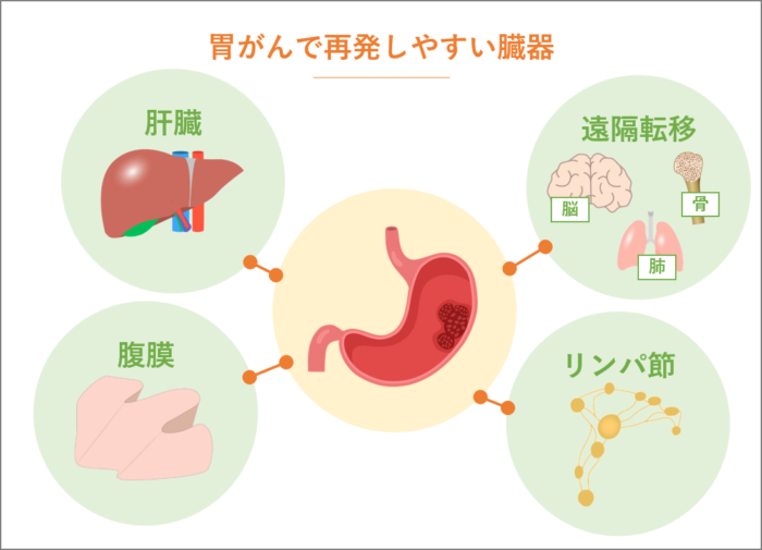 胃がんの再発と頻出する症状