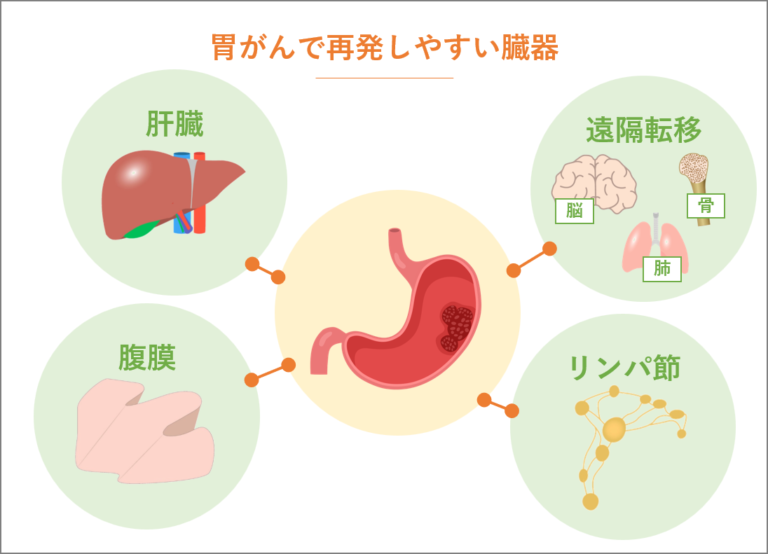 胃がんステージ4(末期)からでも治る可能性をあきらめない