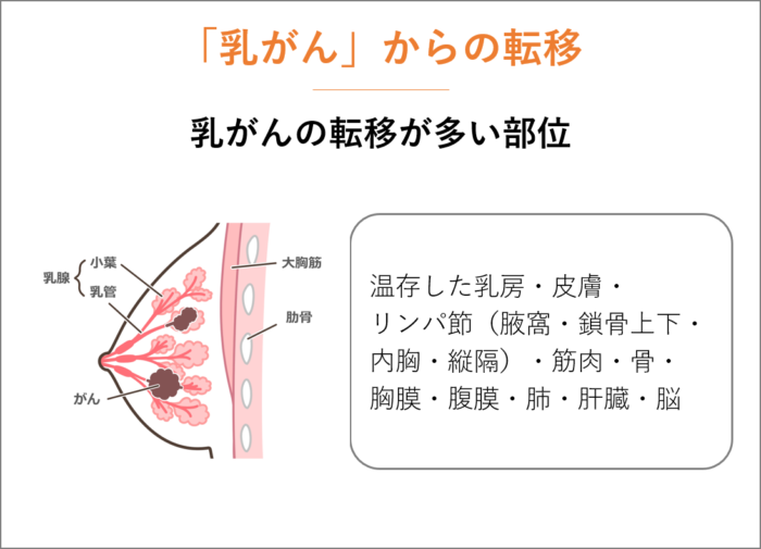 「乳がん」からの転移