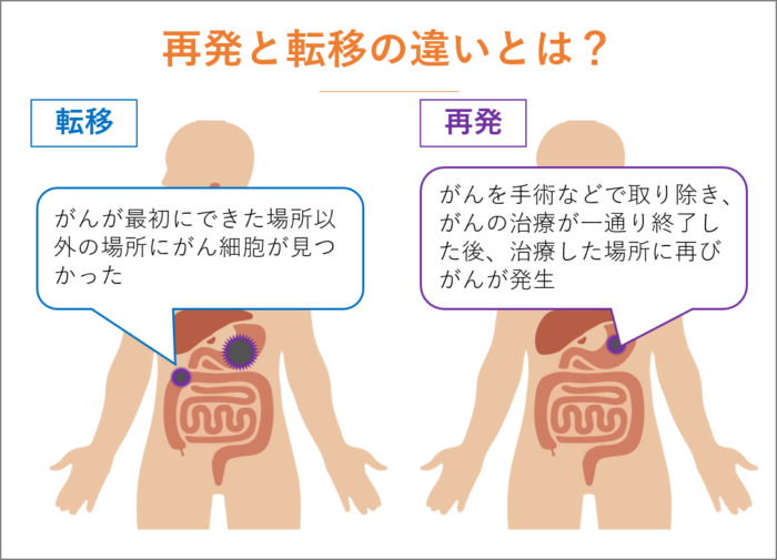 再発と転移の違いとは？