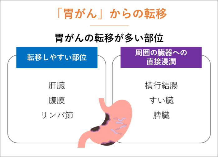 「胃がん」からの転移