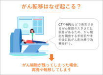 癌が転移してもあきらめない。転移癌が治る確率とその可能性