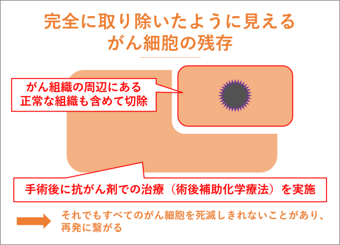 完全に取り除いたように見えるがん細胞の残存