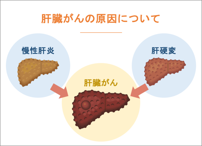 肝臓がんの原因について