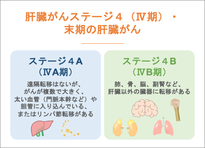肝臓がんステージ４（Ⅳ期）・末期の肝臓がん