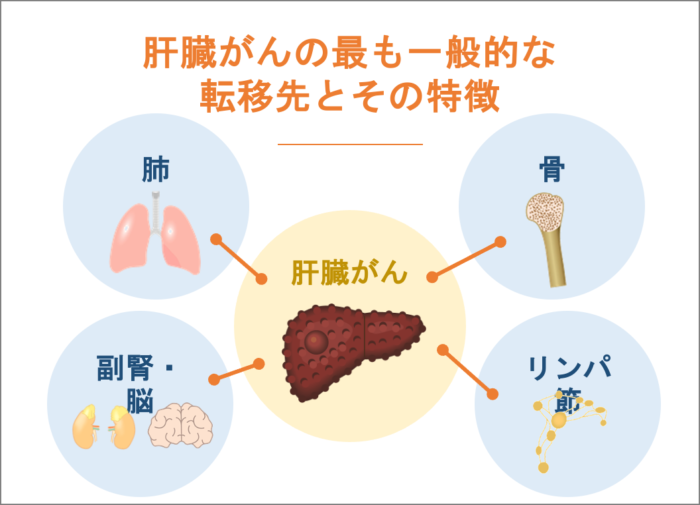 肝臓がんの最も一般的な転移先とその特徴