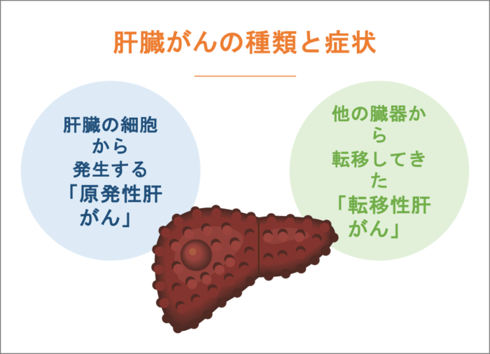肝臓がんの種類と症状