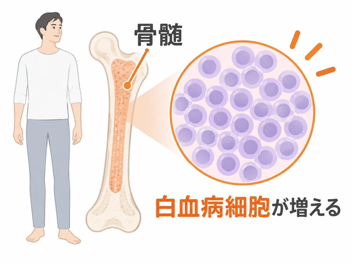 骨の内部の骨髄と、白血病細胞が増える様子を単純化した概念図。