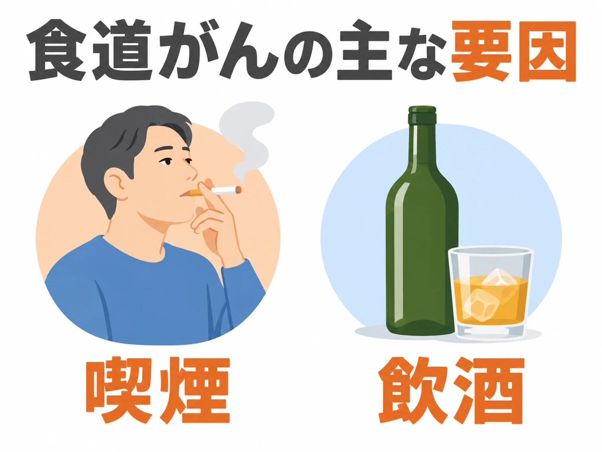 食道がんの主な要因として喫煙と飲酒を示した図。