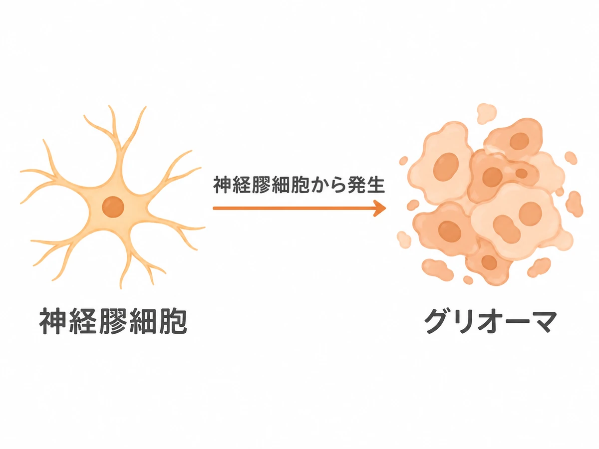 神経膠細胞からグリオーマが発生することを、細胞の模式図で示したイラスト