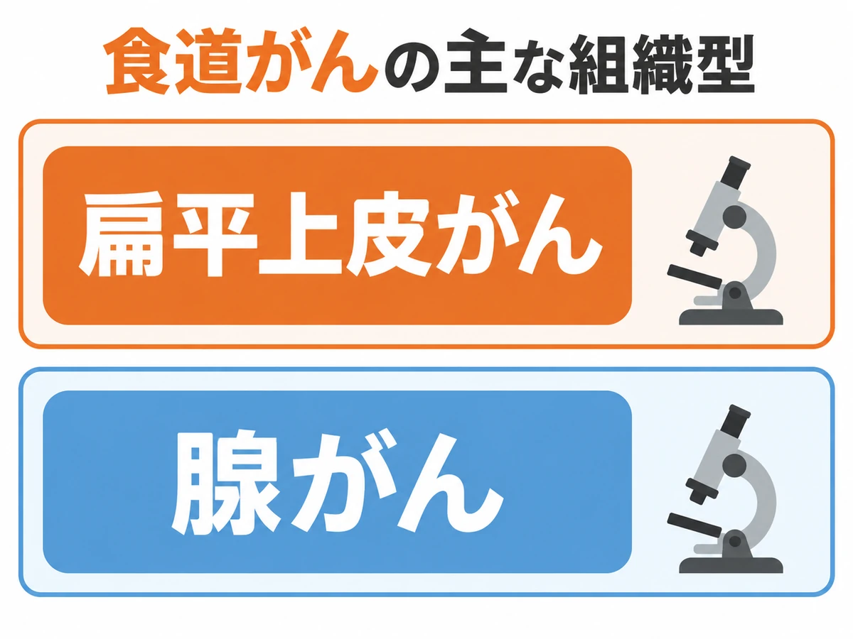 食道がんの主な組織型として扁平上皮がんと腺がんを示す図解