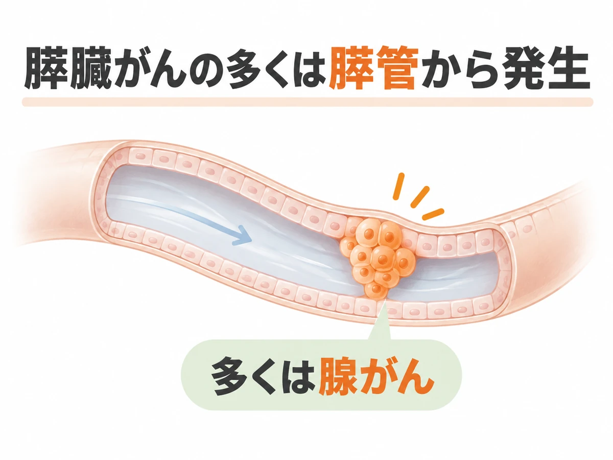 膵管に発生するがんを概念的に描き、多くは腺がんであると説明するイラスト