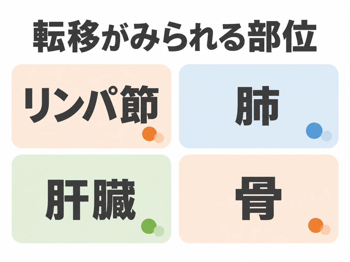 膀胱がんの転移がみられる部位として、リンパ節、肺、肝臓、骨を示した図解。