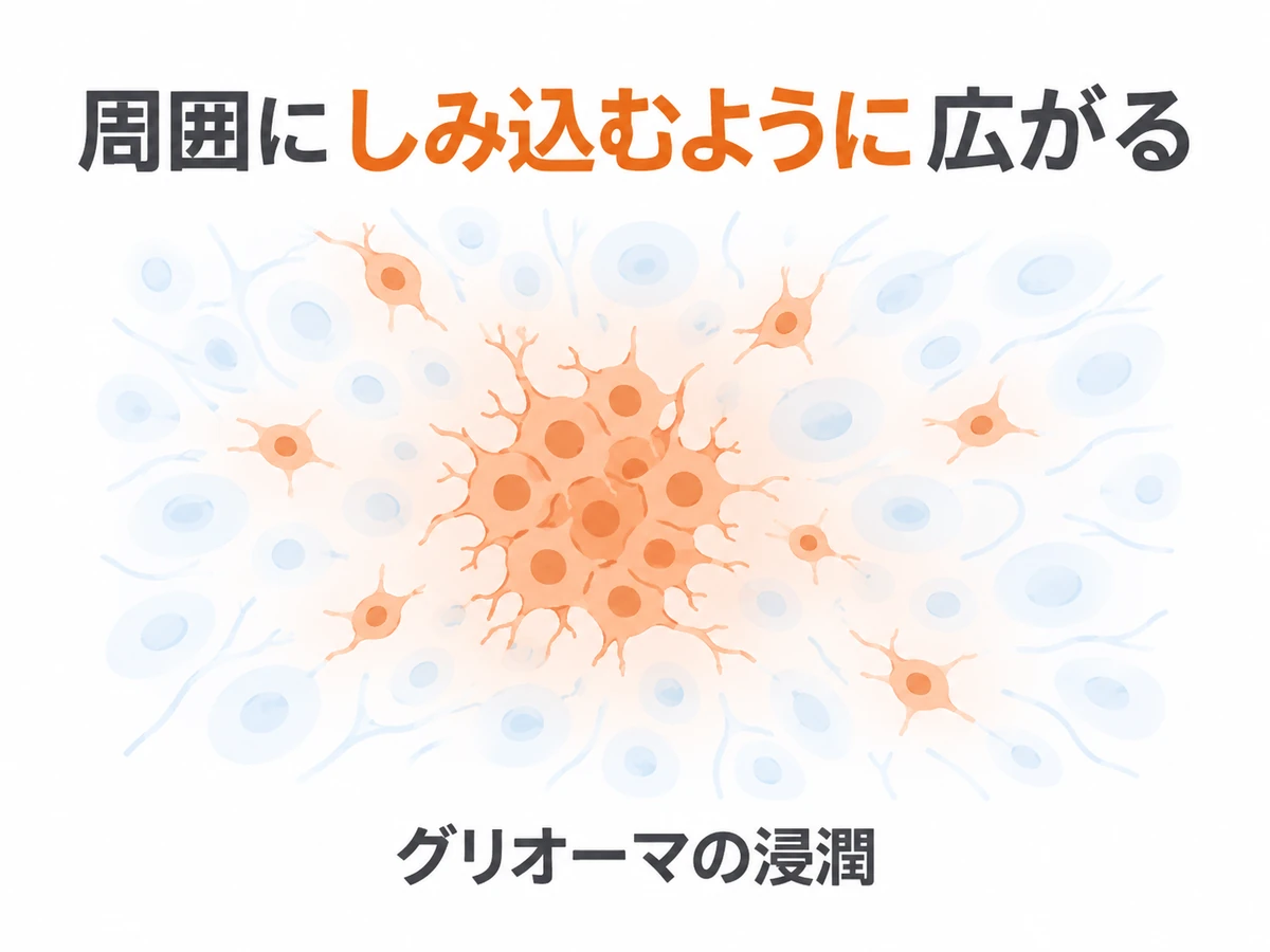グリオーマが周囲にしみ込むように広がる浸潤の性質を、細胞の模式図で示したイラスト