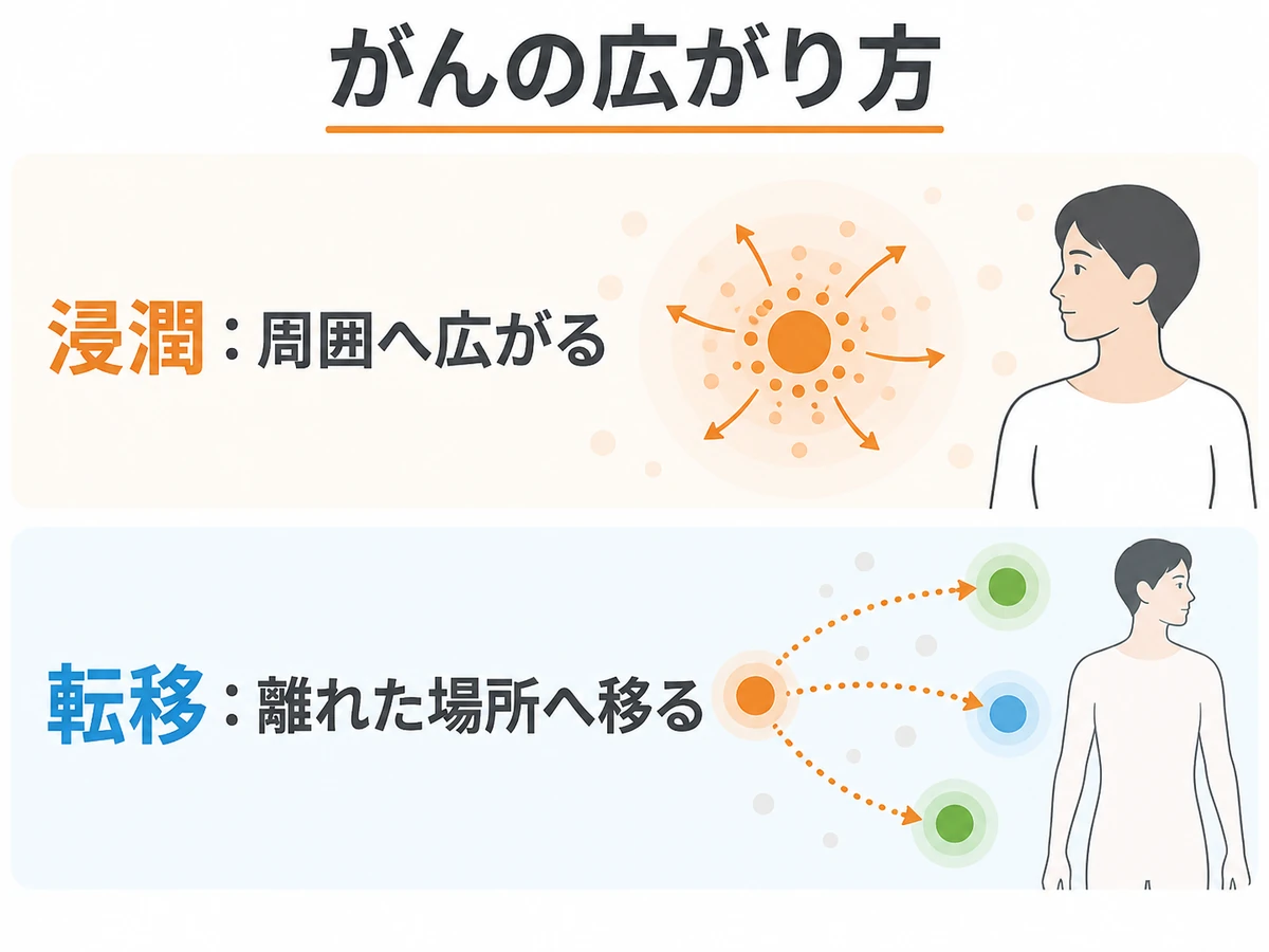 浸潤は周囲へ広がること、転移は離れた場所へ移ることを示す図解