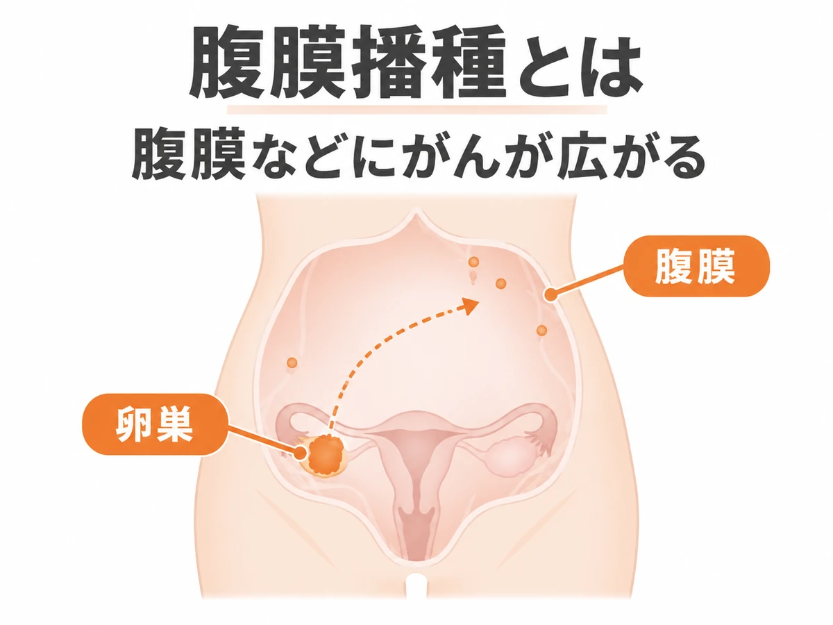 卵巣から腹膜などへがんが広がる腹膜播種の概念を示す模式図。